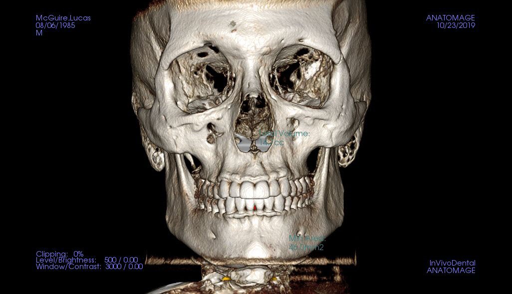 frontal 3D scan of a human skull